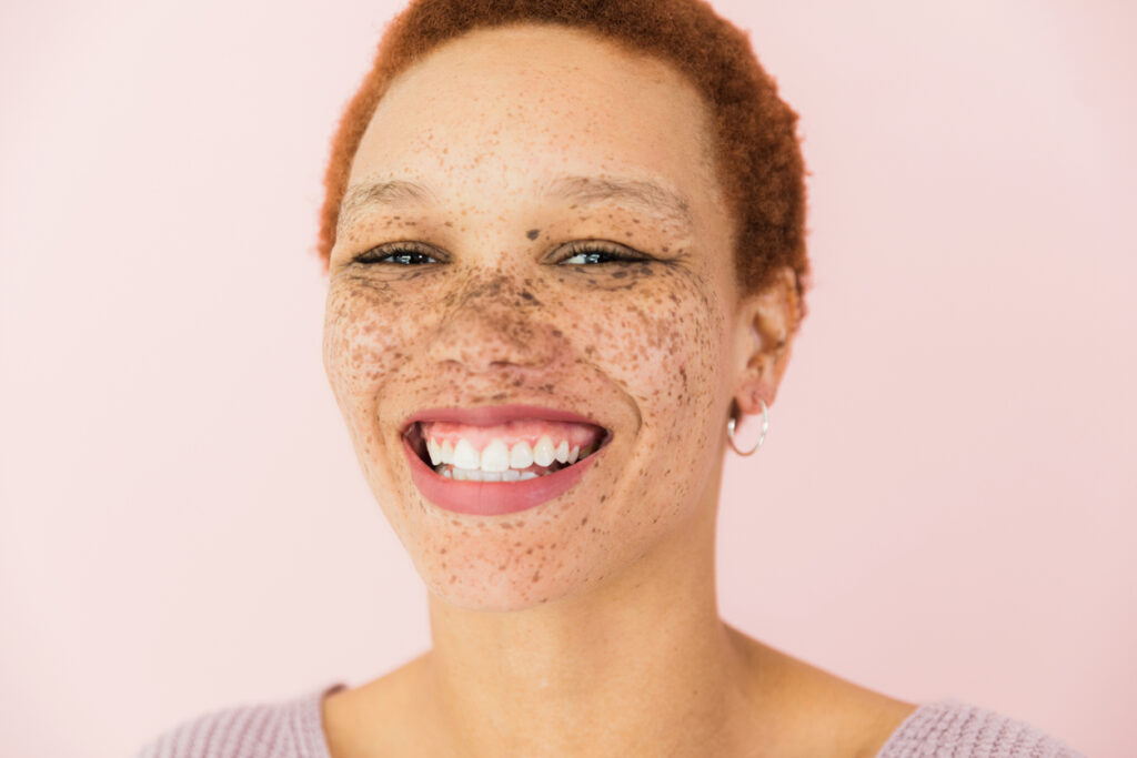 hyperpigmentation treatment