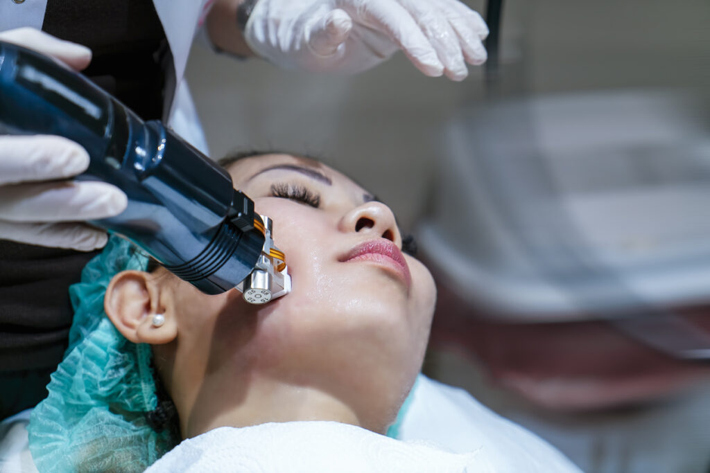 Radiofrequency (RF) Microneedling