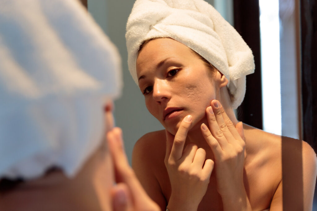 how to get rid of acne scars